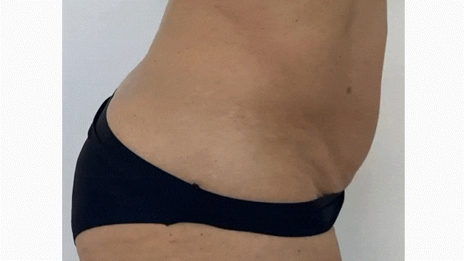 Before-After_Lysiwave_LOW