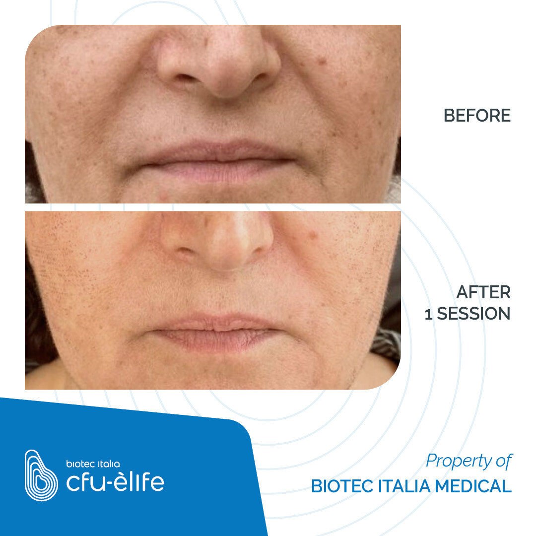 CFU-ELIFE_Before-After_04