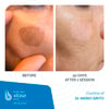 XLASE-PLUS_NPP-QS-NdYAG_Before-After_04