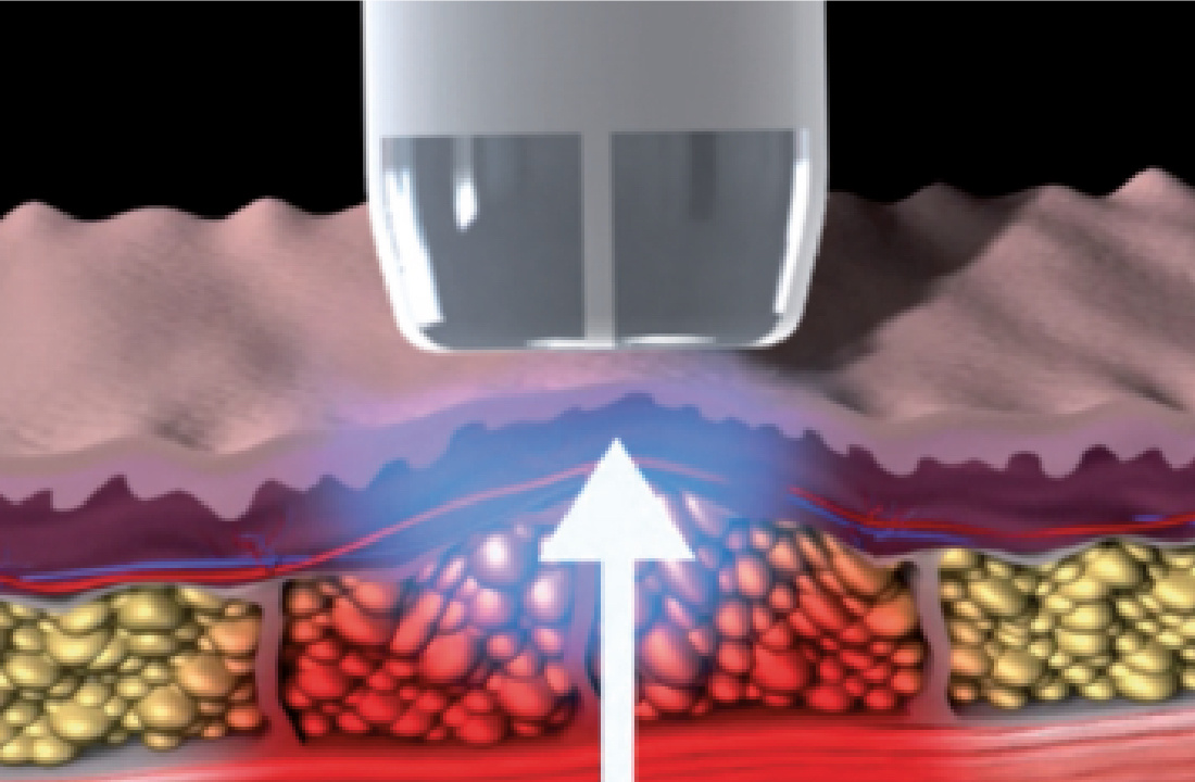 coaxmed-tech-Bipolar_RF_Shape@2x