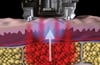 coaxmed-tech-Vaculase@2x