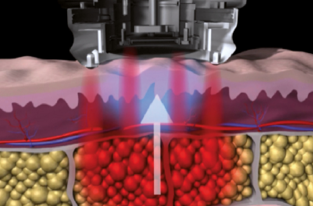 coaxmed-tech-Vaculase@2x